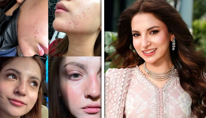 Dananeer Mobeen addressing skin criticism and acne discussion on social media